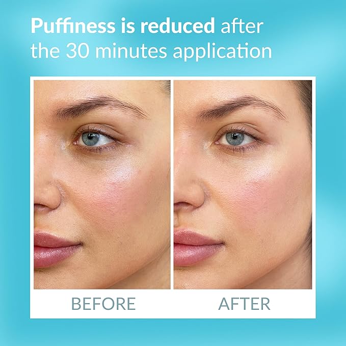 Talika Eye Therapy Patch - Instant Smoothing Under Eye Patches - For Dark Circles Puffiness & Tired Eyes - Reusable Under Eye Patch Skincare Eye Treatment-Velvo Beauty