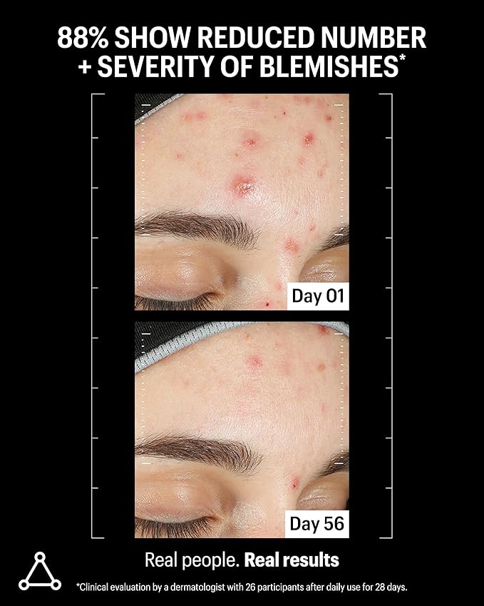 Allies of Skin Azelaic & Kojic Clarifying Face Serum | Clinically Proven for Acne & Blemish Prone Skin |10% Azelaic Acid Treats Pigmentation and Redness | Targets Pores & Uneven Skin Texture (1 Fl oz)-Velvo Beauty