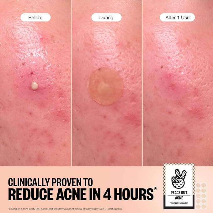 PEACE OUT Acne Healing Dots Helps Clear Blemishes Overnight, Fast Acting Hydrocolloid Pimple Patches for Breakouts with Salicylic Acid, Retinol and Aloe Vera, Award Winning Skincare Solution 60 Count-Velvo Beauty