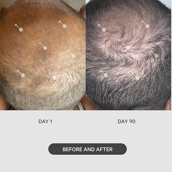 DS Labs StimuROLLER Hair Micro-Needle Hair Stimulation System 0.25mm, Packaging May Vary-Velvo Beauty