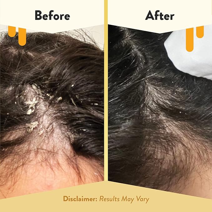 ECZEMA HONEY Soothing Scalp Oil - Natural Honey Hair Oil & Scalp Care - Daily Itchy Scalp Relief Serum - Dry Scalp Treatment Helps With Psoriasis, Seborrheic Dermatitis, Dandruff & More (1 Oz)-Velvo Beauty