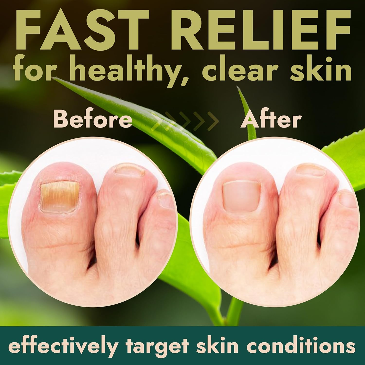Nail Fungus Treatment Extra Strength for Toenail & Fingernails | Antifungal Nail Treatment with Tea Tree Oil | Fast-Acting, No-Touch Applicator | Restores Thickness & Discoloration | 20g-Velvo Beauty
