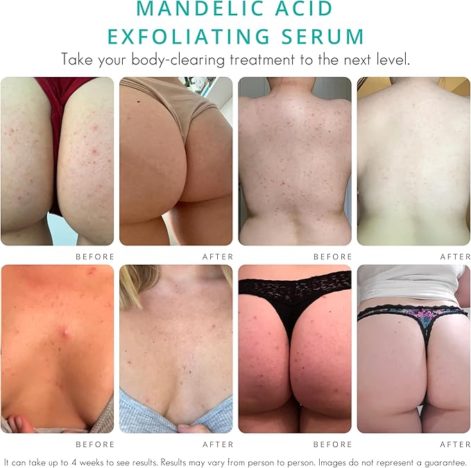 Level 2 Serum | Mandelic Acid Body Serum for Acne, Folliculitis, Aging Skin, Ingrown Hairs, Dark Spots on Face, Chest, Butt, Back, Thighs, Arms | 4 oz-Velvo Beauty