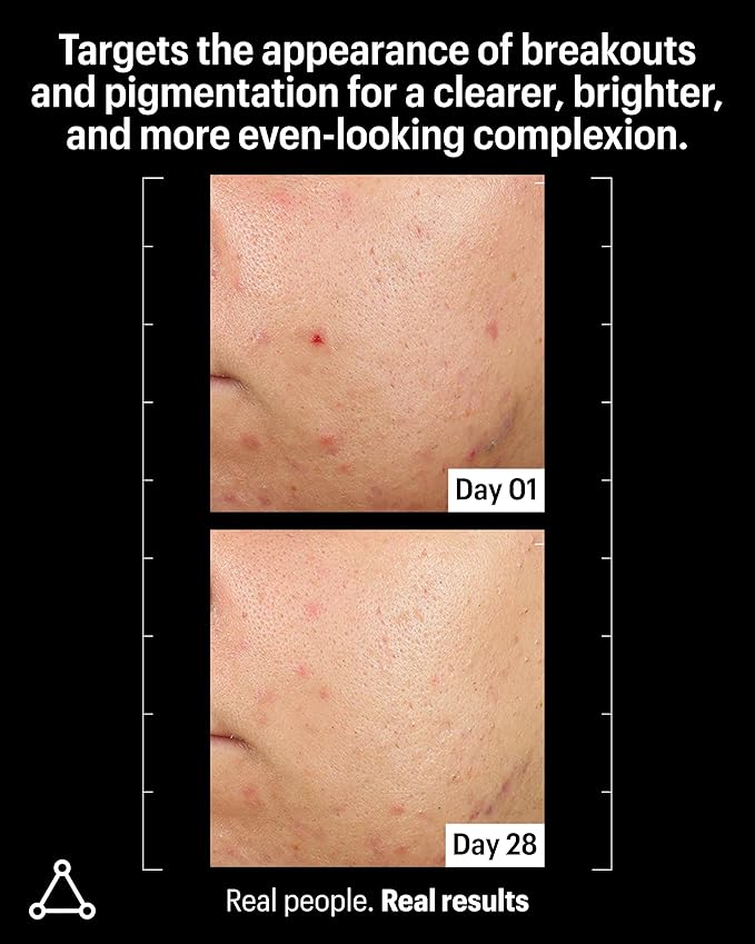 Allies of Skin Azelaic & Kojic Clarifying Face Serum | Clinically Proven for Acne & Blemish Prone Skin |10% Azelaic Acid Treats Pigmentation and Redness | Targets Pores & Uneven Skin Texture (1 Fl oz)-Velvo Beauty