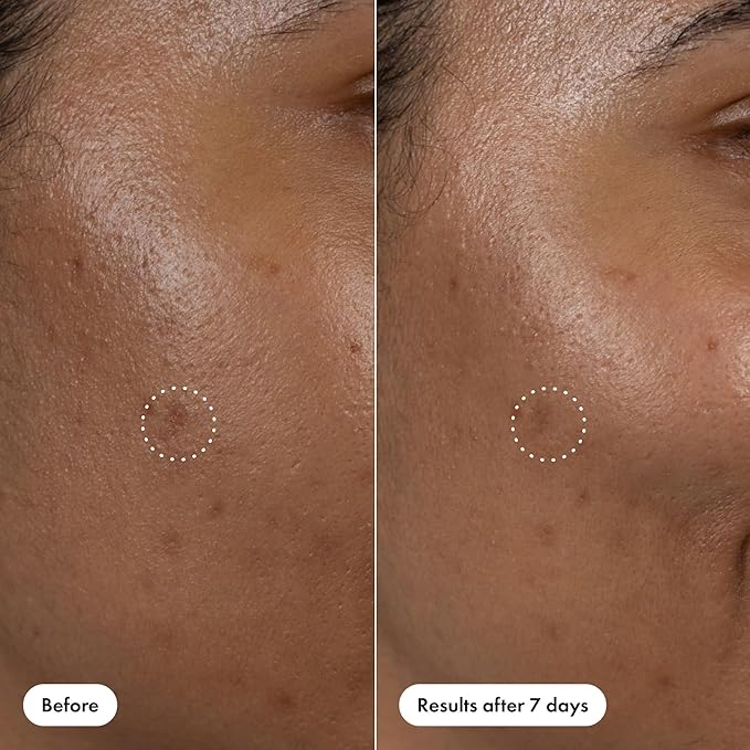 Hero Cosmetics Dark Spot Correct Spot-Fading 15% Vitamin C plus Hyaluronic Acid Serum. Improves the Look of Post Blemish Marks in 7 Days. Twist Applicator and Rollerball Tip for Easy Application. 10mL-Velvo Beauty