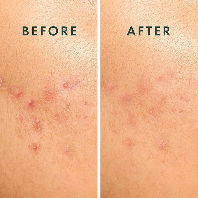 Rael Pimple Patches, Miracle Spot Control Cover - Hydrocolloid Acne Patch, Strips for Zits and Blemish, Korean Skin Care, Vegan, Cruelty Free (20 Count)-Velvo Beauty