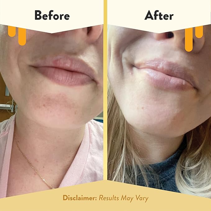 ECZEMA HONEY Nourishing Lip Balm - Organic Chapstick for Sensitive Skin - Daily Lip Moisturizer for Very Dry Lips - Mango Butter & Honey Lip Balm - Natural Lip Care Products (1 Ct)-Velvo Beauty