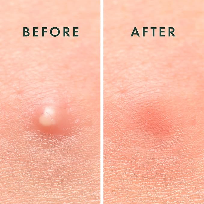 Rael Pimple Patches, Miracle Invisible Spot Cover - Hydrocolloid Acne Patch, Treatment for Breakouts, Absorbs Zits & Blemish, Korean Skin Care, 2 Sizes (24 Count)-Velvo Beauty