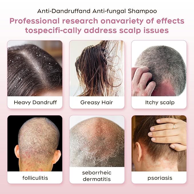 24HR Fast Itch Relief Anti-Fungal Shampoo for Psoriasis, Seborrheic Dermatitis & Folliculitis, Relieves Itchy, Dry Scalp, Sulfate & Paraben Free Anti-Dandruff Shampoo for Men and Women, 8.4 fl oz-Velvo Beauty