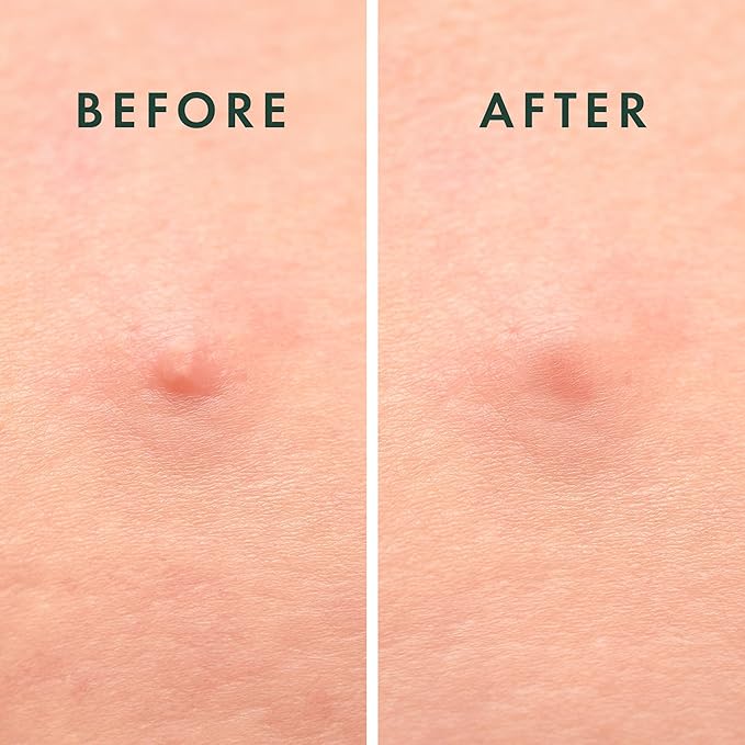 Rael Pimple Patches, Miracle Microcrystal Spot Cover - Hydrocolloid Acne Patch with Tea Tree Oil, Early Stage Zits and Blemish, Korean Skin Care, Vegan, Cruelty Free (9 Count)-Velvo Beauty