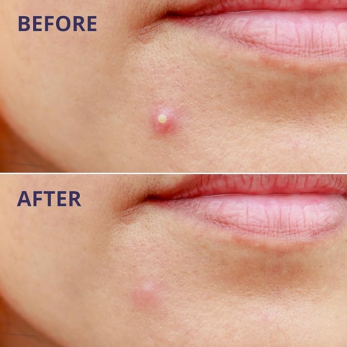 Pimple Patches for Face (96 Count). Invisible Hydrocolloid Acne Patch for Blemishes, Zits, and Breakouts. Easy-to-Use Spot Cover for Day & Night, One Size - Medium (12mm)-Velvo Beauty