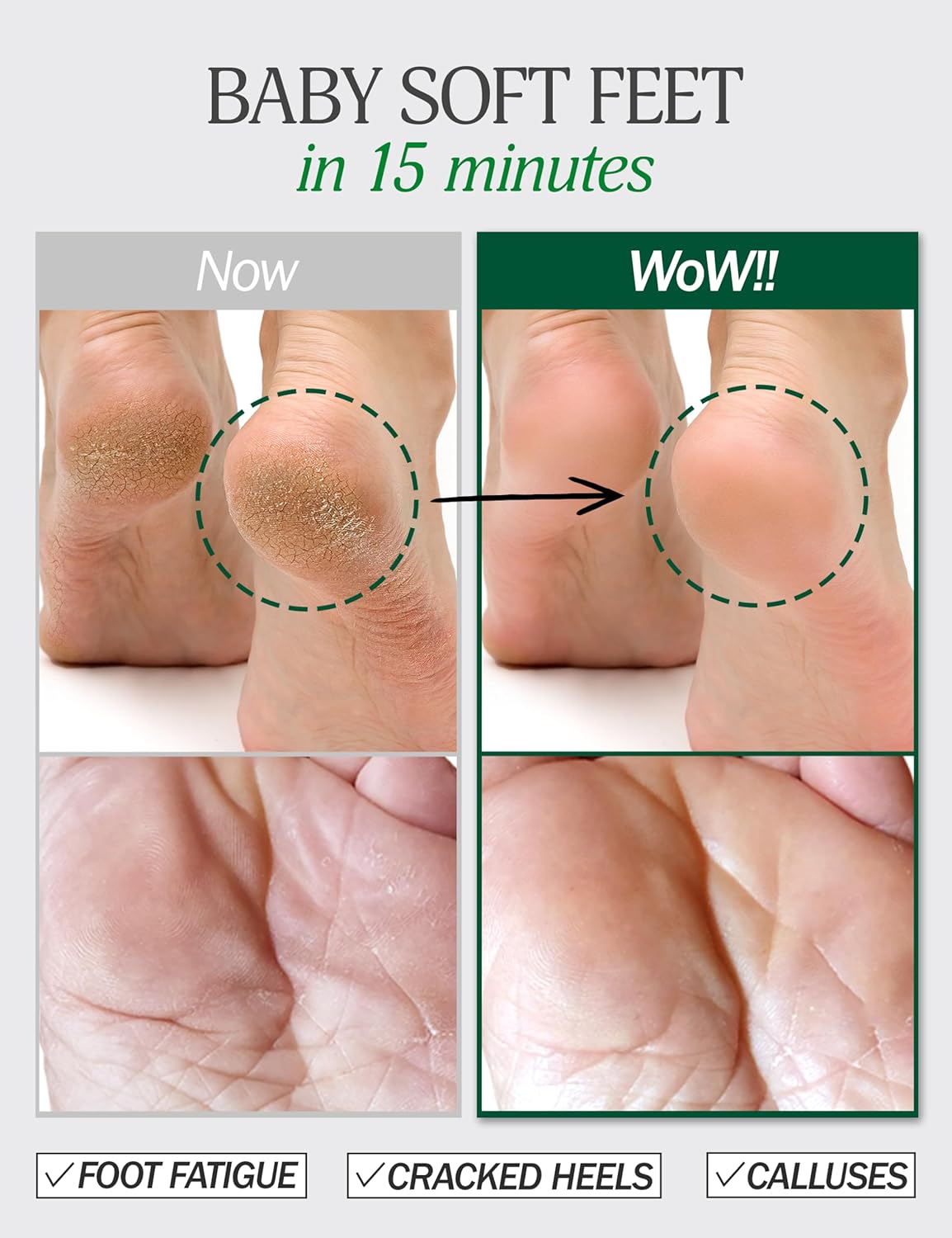 Moisturizing Foot Mask for Dry Cracked Feet | Hydrating at Home Foot Spa Kit Baby Feet Foot Peel Cracked Heel Repair w/Natural Ingredients | No More Dry Rough Calloused Feet (5 Pairs)-Velvo Beauty