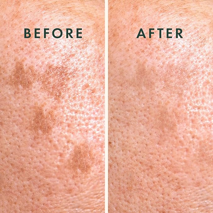 Rael Pimple Patches, Miracle Microcrystal Vitamin C Dark Spot Cover - Hydrocolloid Patch with Glutathione and Niacinamide, Treatment for Post Acne, Korean Skin Care, Vegan, Cruelty Free (9 Count)-Velvo Beauty