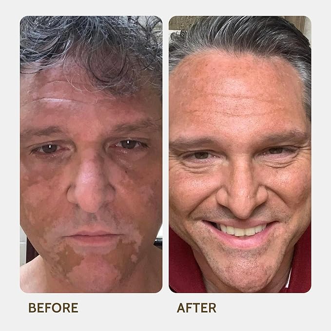 Vitiligo Vanquish Cosmetic Camouflage Kit by Fake Bake Liquid Concealer, Long Lasting Natural Color Customization Eliminates Appearance of Skin Depigmentation For Women & Men - Cover Lasts For Days-Velvo Beauty