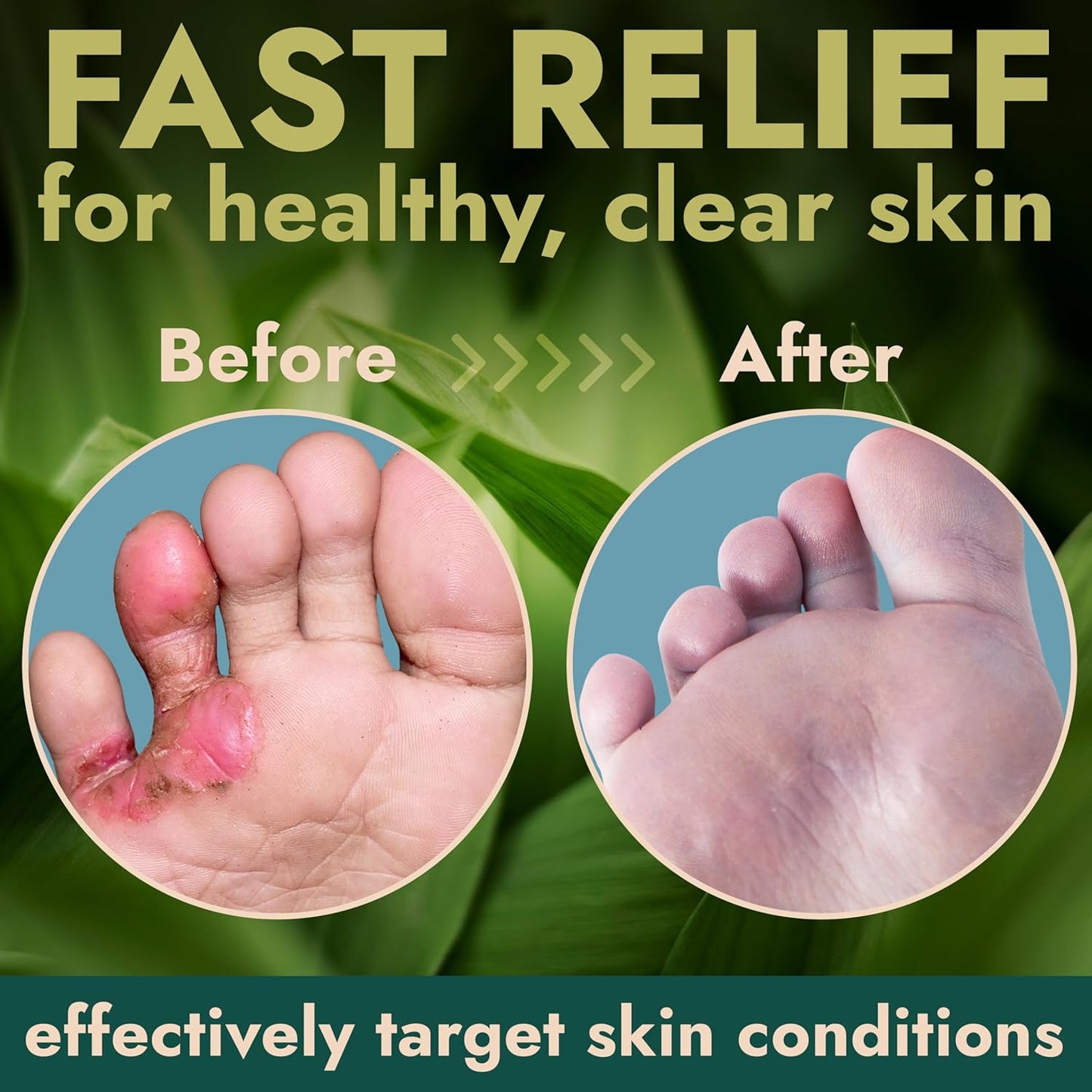 Tea Tree Oil Antifungal Foot Gel | Relieves Jock Itch, Athlete’s Foot & Ringworm | Soothes Itching & Burning | Moisturizes Dry, Cracked Feet | No-Touch Applicator | 1-Week Treatment Option | 20g-Velvo Beauty