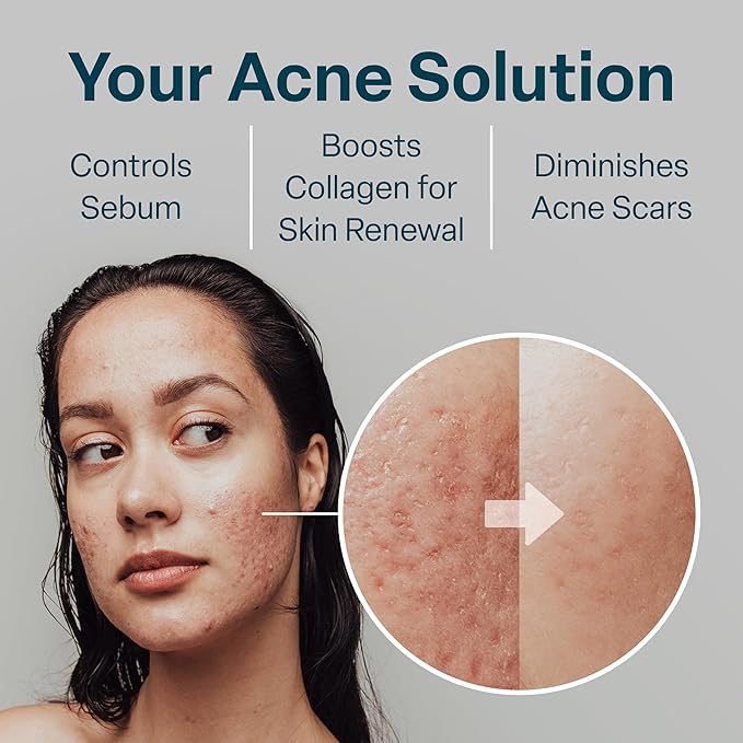 QRxLabs Salicylic & Glycolic Acid Acne Control Pads - 50 Count Jar - Glycolic & Salicylic - Bacne Treatment with Vitamins B5, C & E, Calendula & Green Tea-Velvo Beauty