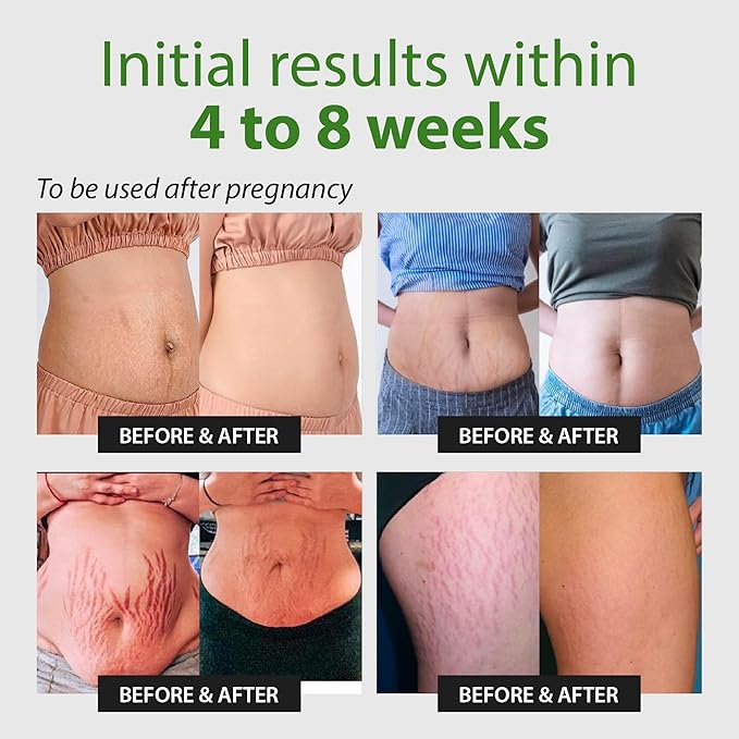 Abera Ovela Stretch Mark Cream, Stretch Marks Treatment For Pregnancy and Weight Fluctuations, Effective Treatment for Stretchmarks in All Skin Types (A. 1 Box + Ice Roller)-Velvo Beauty