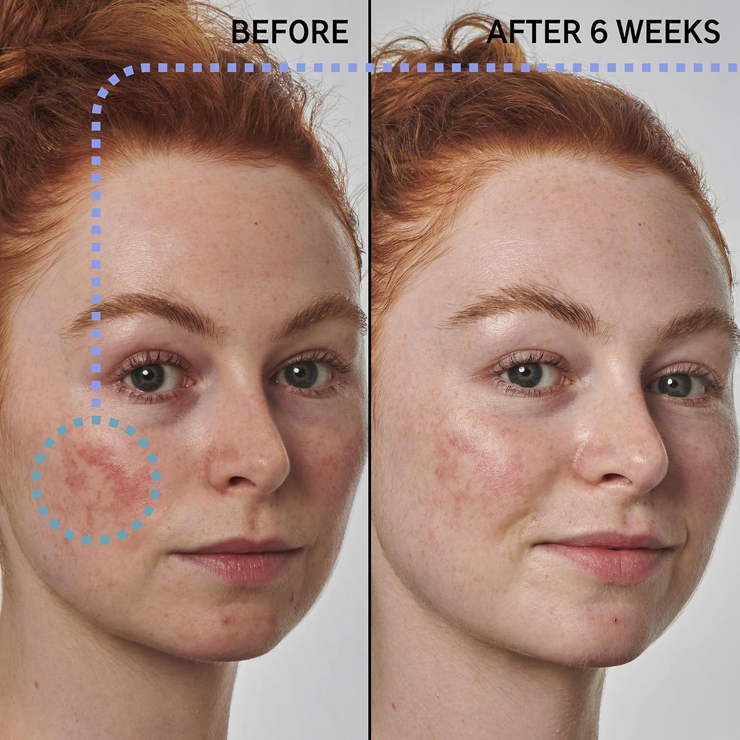 The INKEY List SuperSolutions Azelaic Acid 10% Serum, Fast-Absorbing Formula Helps Reduce Appearance of Redness and Soothes Skin, Leaves No White Cast, 1.01 fl oz-Velvo Beauty