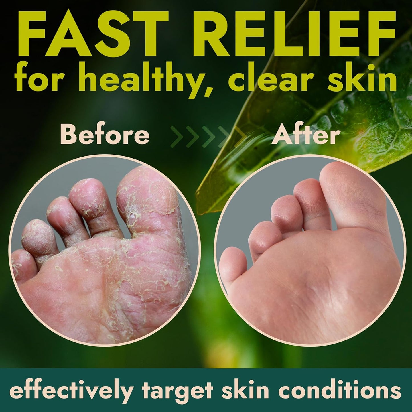 Foot Cream with Tea Tree Oil | Antifungal Cream to Soothes Cracked Heels, Dry Skin & Itchy Feet | Helps with Athlete’s Foot, Nail Fungus & Jock Itch | Relieves Itching & Burning | 4.05 fl oz-Velvo Beauty