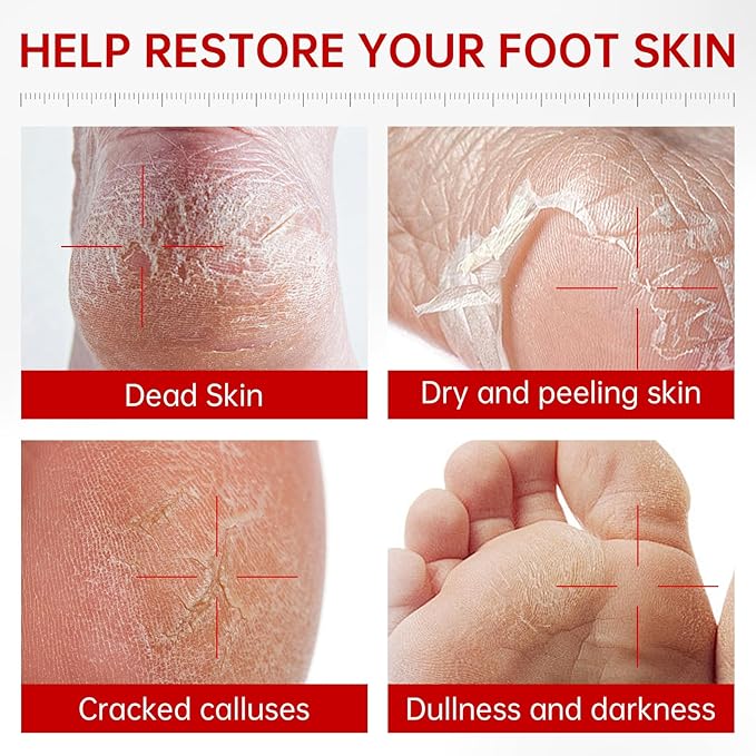 3 Pack Foot Peeling Mask, Hydrating Exfoliating Foot Mask for Dry Cracked Feet, Callus Remover & Cracked Heel Repair & Foot Care-Velvo Beauty