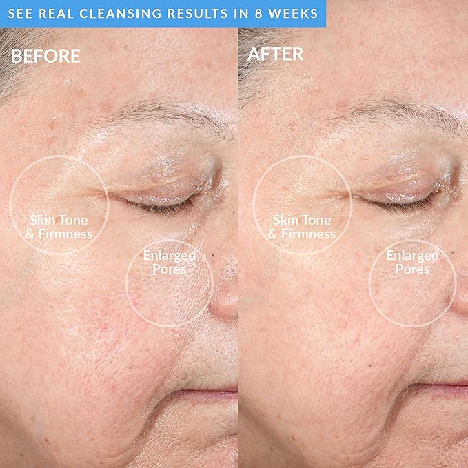 PMD Beauty Facial Cleansing Brush - Smart Silicone Brush with Blue Light Treatment - SonicGlow Vibration - Waterproof Device for Acne-Velvo Beauty