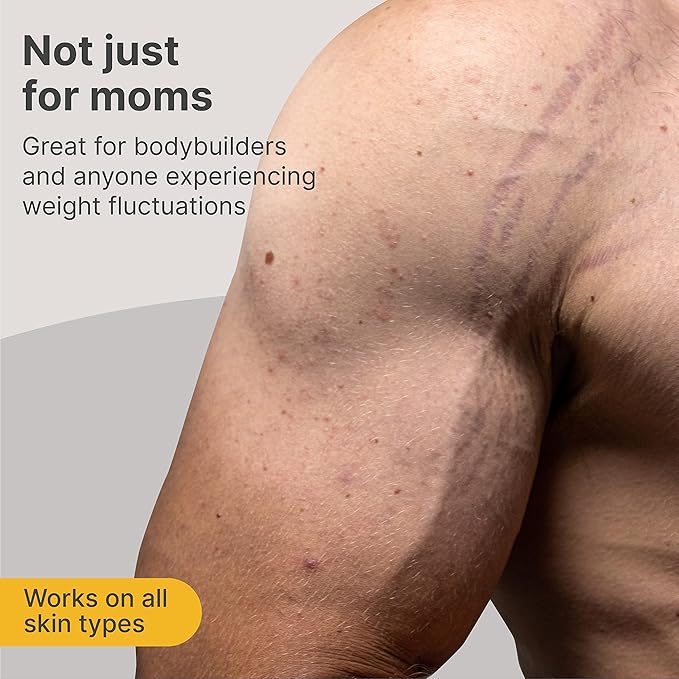 TriLASTIN-SR Intensive Stretch Mark Cream (5.5oz) Bundle with Nipple & Lip Balm (3pk) | Fast-Acting Stretch Marks Cream with Absorption Enhancing Serum | Breastfeeding & Ingesting Safe Balm-Velvo Beauty